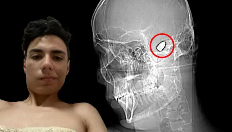 Kafasında Patlayıcı Madde Taşıyan Genç: Hayatı Tehlikede